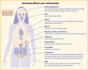 anorexia - info