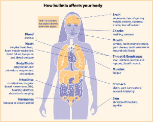 bulimia - info